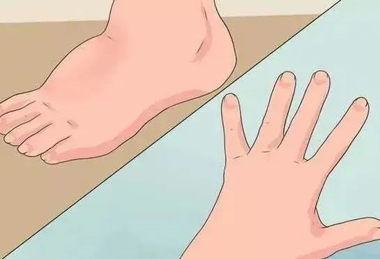 下肢总有水肿怎么回事?名中医王清海教授教你消掉水肿