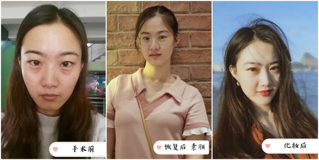 做完医美真的能换脸吗,做完医美需要注意什么