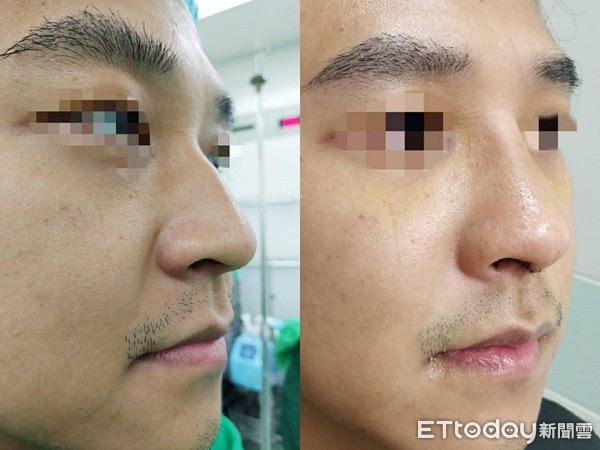 鼻中隔塌陷重建风险大吗,鼻梁歪曲伴有鼻甲肥大