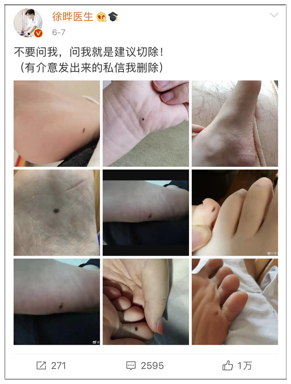 容易癌变的痣去哪里切除,从小就有的痣要切除吗