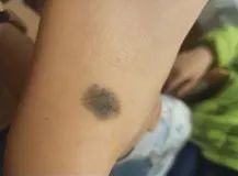 容易癌变的痣去哪里切除,从小就有的痣要切除吗