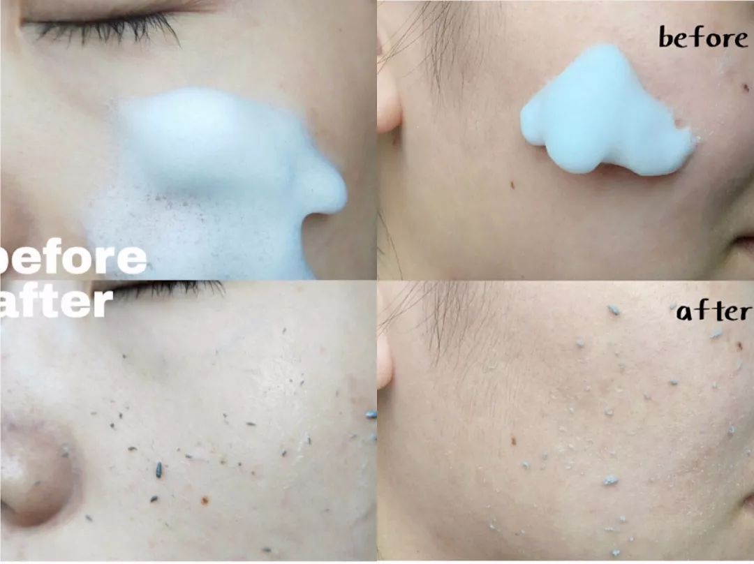 挤痘痘出来的白色长条状是什么,痘痘黑头挤出白颗粒