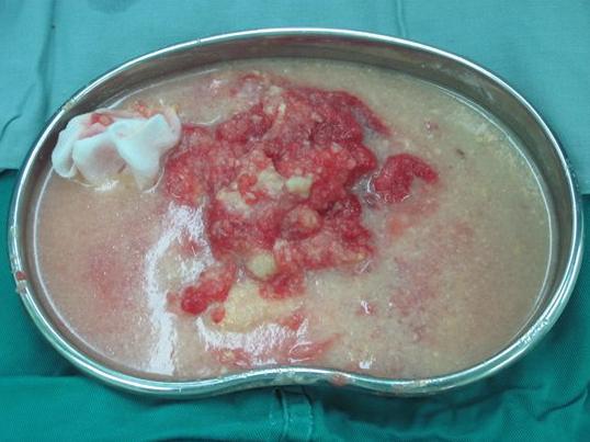 奥美定隆胸取出后凹陷,奥美定隆胸后取出算大手术吗