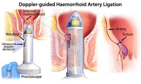 超声多普勒引导下痔疮手术多少钱,超声多普勒治疗痔疮优缺点