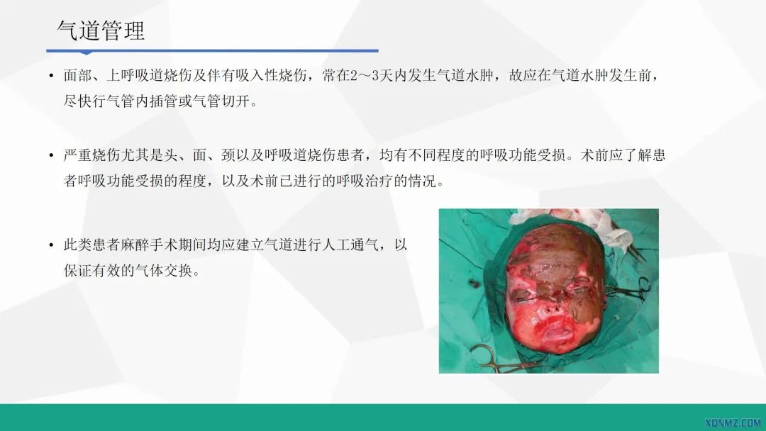 外科烧伤病人的护理教学视频,烧伤患者护理教学查房讲解视频