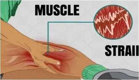 运动肌肉拉伤看哪个科,运动肌肉拉伤贴什么药