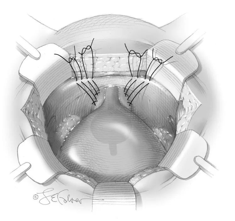 出现压力性尿失禁怎么解决,因为压力大尿频怎么办