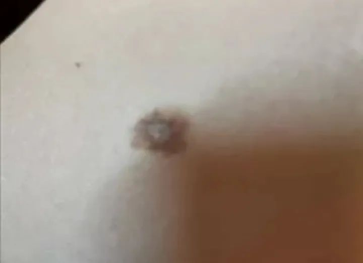 黑痣癌变的痣会很大吗,黑痣癌变一般是一个痣还是好多