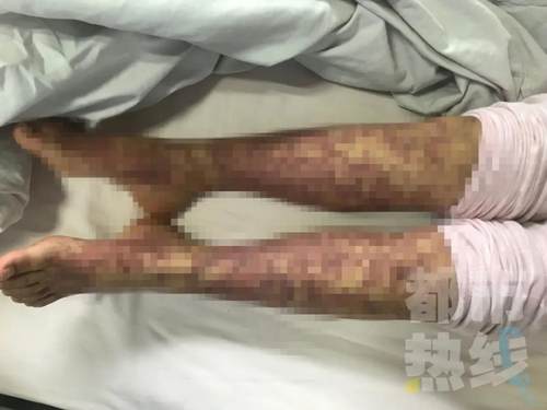 西安7岁女孩吃了一串烤鱿鱼致旧疾复发，医生提醒：这类人远离海鲜产品