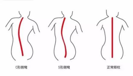 孩子弯腰驼背高低肩,孩子弯腰驼背体态难看