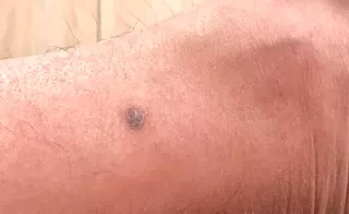 黑痣癌变的10个征兆,黑痣癌变从发病到去世不到两个月