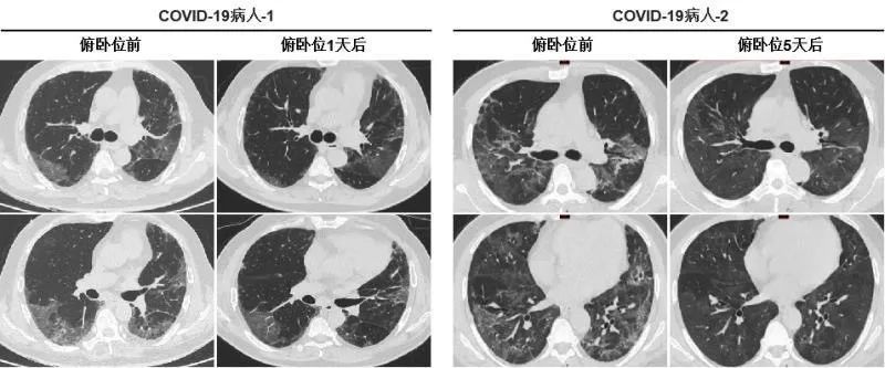 新闻｜我校交叉科学研究院刘三宏研究员与合作者共同发现一种可明显改善COVID-19重症患者血氧饱和度的方法