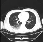 新冠化湿败毒中药方,新冠湿毒