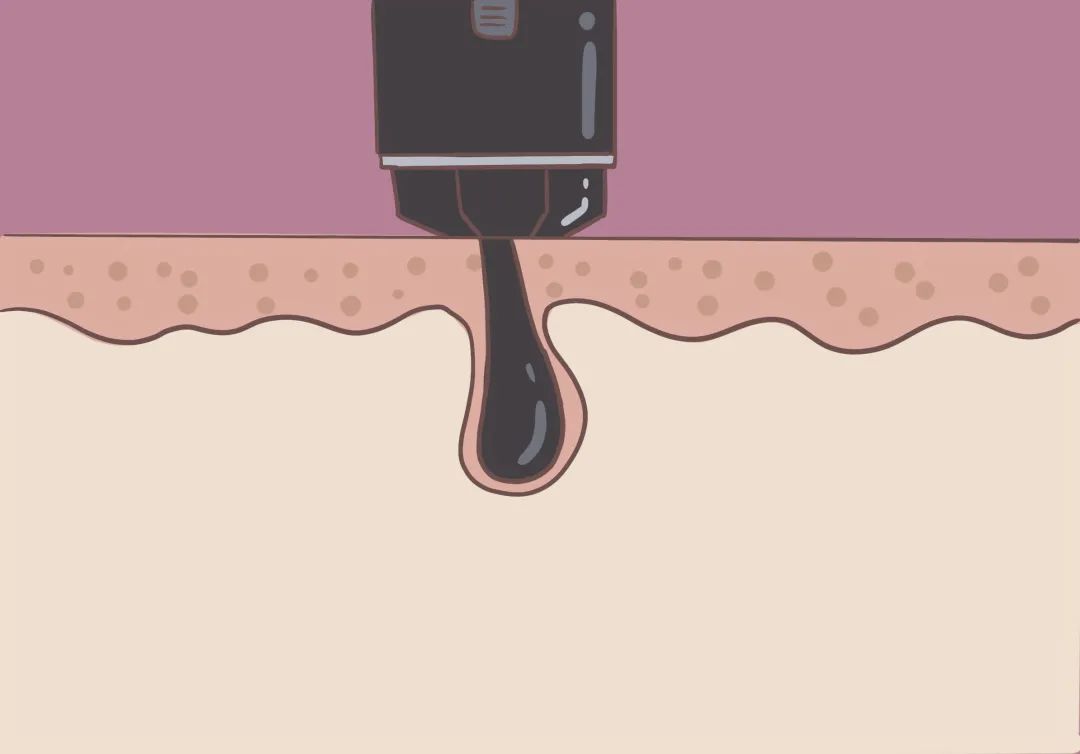 胸毛、脚趾毛、*处私**的毛能不能脱?一篇说清楚