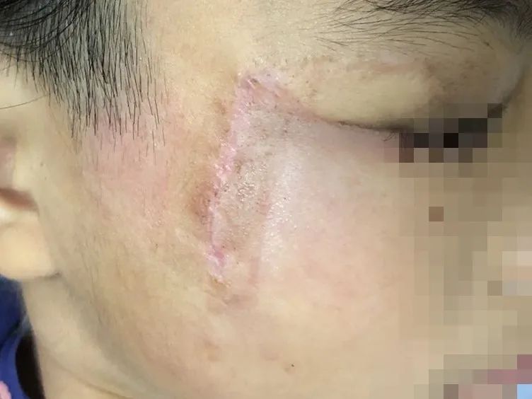 【专家在身边】右脸大面积黑斑,还长毛发!2年多的精心治疗,让大眼萌娃有了正常肤色