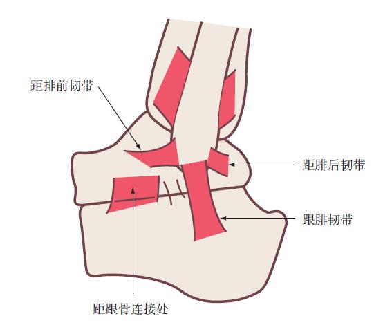 踝关节损伤的处理7条助你应对,踝关节韧带损伤多久能恢复正常