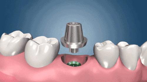 种植牙科普：揭秘种植牙修复全过程，每个步骤都很重要