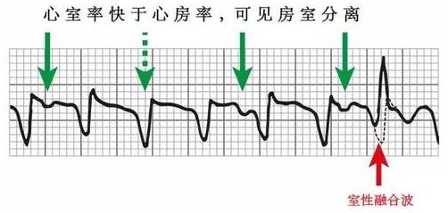 室速全名叫什么,室速的解读和识别