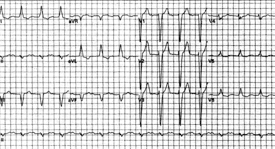 室速属于重大疾病吗,室速的相关资料