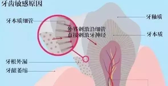 瑞士国民牙膏治牙敏感,牙齿酸用抗敏感牙膏有效
