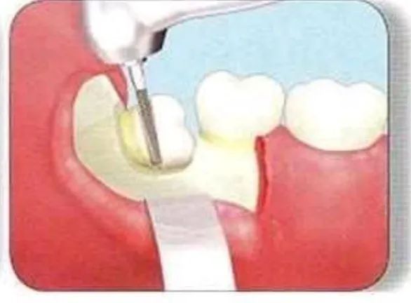 智齿组图,智齿大全