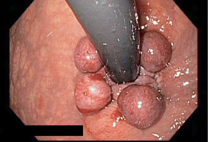 有痔人士的福音内痔的内镜下治疗,胶圈套扎痔疮疗法可以自己做吗