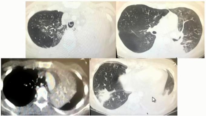 支原体肺炎症状应该注意什么,支原体肺炎这些症状要警惕