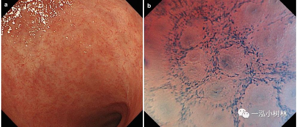 炎症性肠病内镜下表现,炎症性肠病早期筛查结果