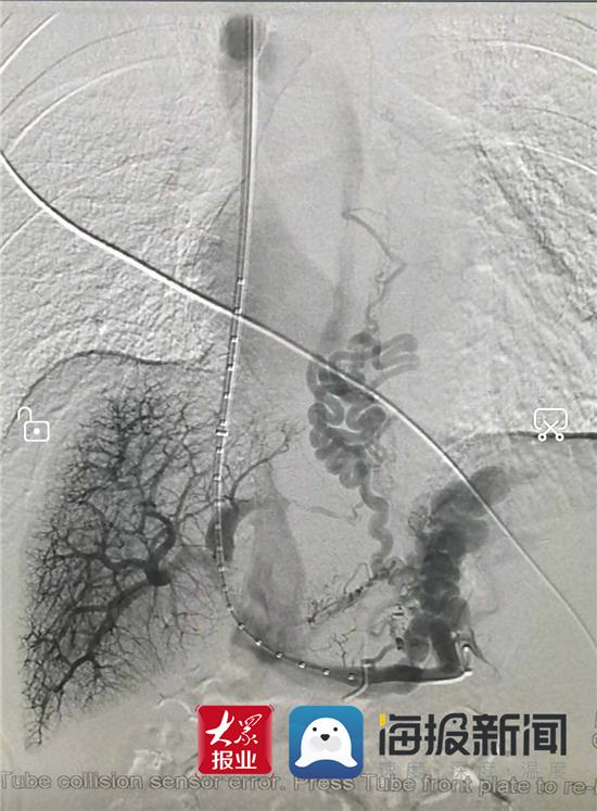 万杰医院手术成功率,万杰青医生做介入技术如何