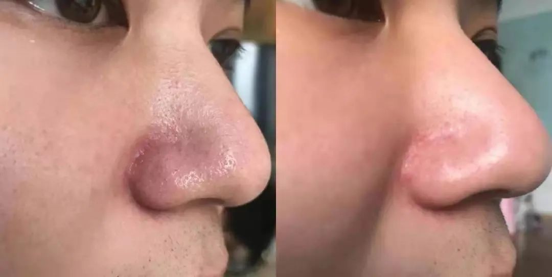 痘痘闭口挤出来的是什么,闭口痘痘挤出来白色物质