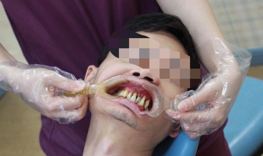 年轻牙齿掉光是什么因果,年轻人牙齿全部一次性掉光