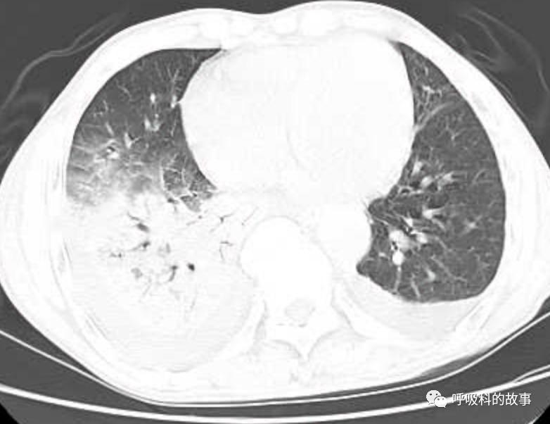 肺炎的最佳治疗方法及药物,肺炎的治疗方法和流程
