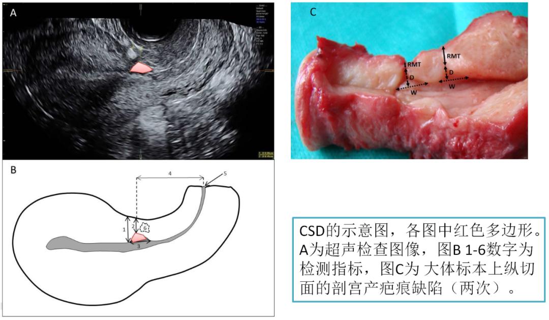 剖宫产术后有多少人有憩室,剖宫产后再次妊娠顺产大出血概率