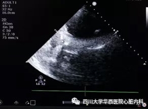 华西心脏外科权威专家,成都华西二院先天性心脏手术专家