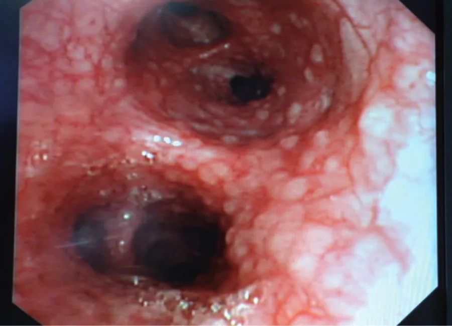 粟粒状肺结核肺部ct表现,粟粒型肺结核ct图