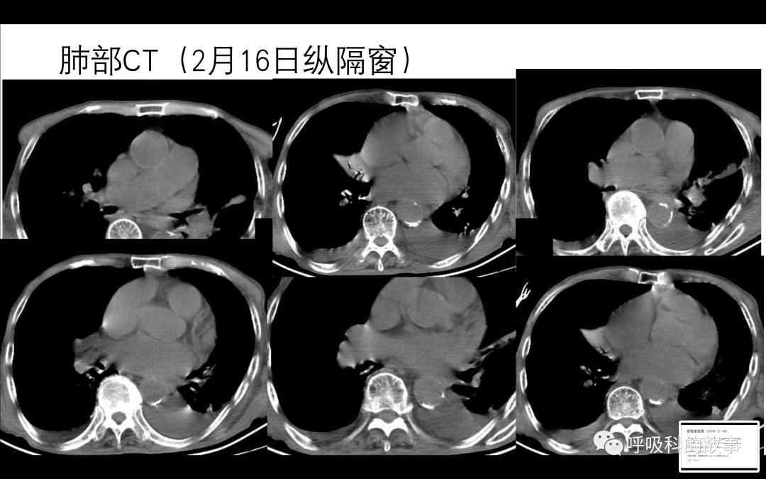 痰液细菌培养及药敏怎么看,痰液培养敏感菌要多久