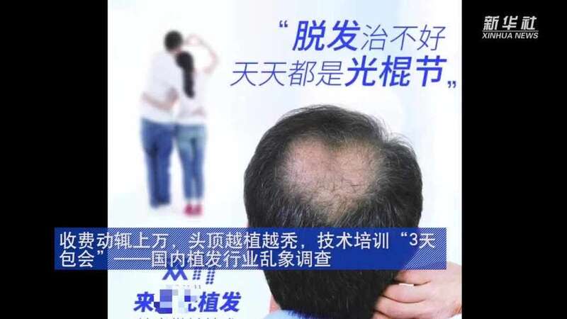 植发三天速成班合法吗,碧莲盛植发靠谱吗正常的植发价格