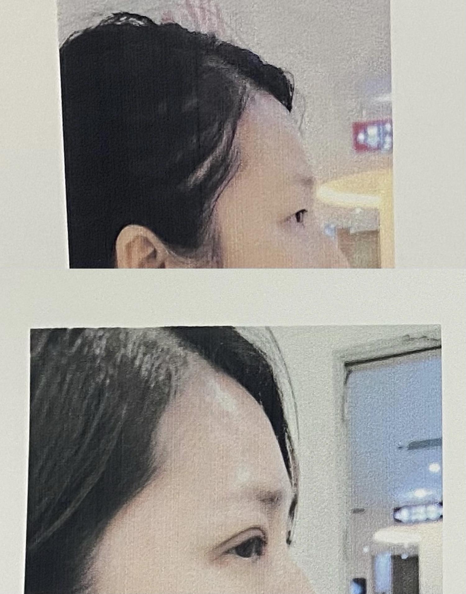 深圳华美整形医院双眼皮,深圳女子美容院割双眼皮