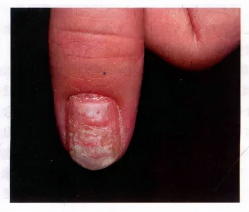 脚指甲变厚有竖纹是怎么回事,脚趾甲变黄变厚有竖纹是咋回事