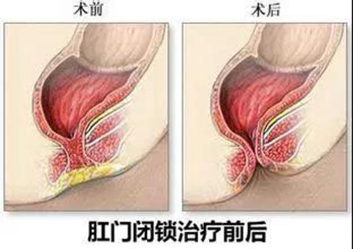 先天性婴儿直肠会阴瘘好治疗吗,幼儿先天性直肠瘘