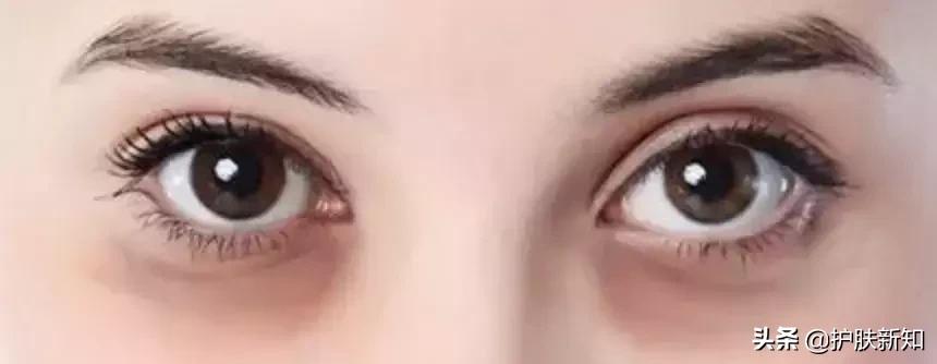 太有才了，竟然有人拿痔疮膏治疗黑眼圈