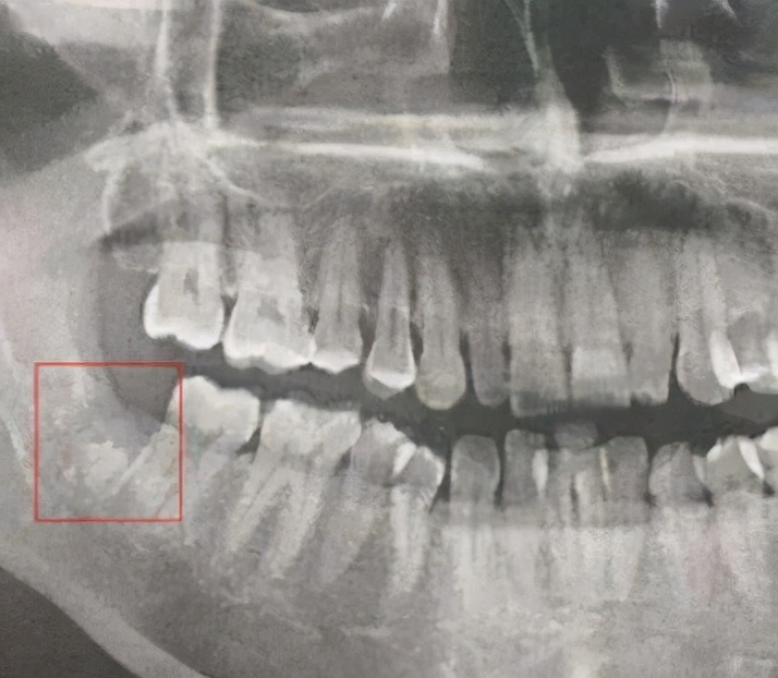 拔牙后干槽症清理过了但是还疼,拔牙三天了可以排除干槽症吗