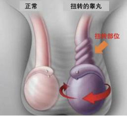 睾丸扭转720度手术后多久能恢复,睾丸扭转90