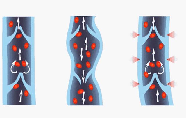 为什么老年人会腿静脉曲张,老人手背血管明显是什么原因