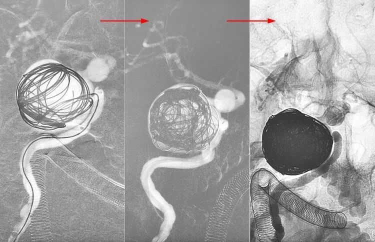 国外怎么治疗动脉瘤,全世界颅内动脉瘤最佳的治疗