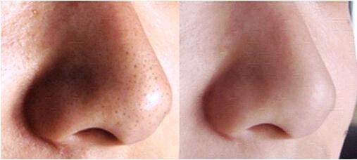 去鼻子上黑头粉刺镊子清理过程,自己挤鼻子黑头粉刺的正确方法