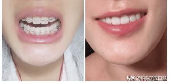 牙齿矫正需要多少时间完成,牙齿矫正后需要戴保持器多长时间