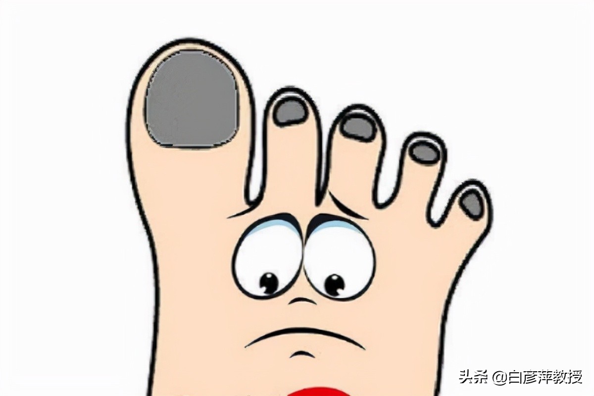 灰指甲是灰色的吗？灰指甲真的会传染吗？皮肤科医生告诉你