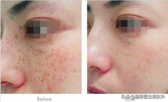 医生为何不做光子嫩肤,为什么医生不建议做光子