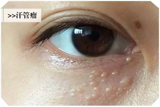 小孩眼周长扁平的疙瘩是怎么回事,眼周有小疙瘩用什么药物可以去除